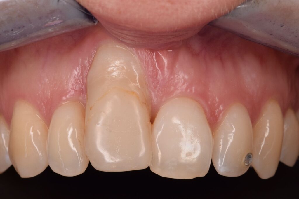 FATTORI CHE INFLUENZANO LA PRESERVAZIONE OSSEA  IN IMPLANTOLOGIA (Marginal Bone Loss) PER IL SUCCESSO A LUNGO TERMINE